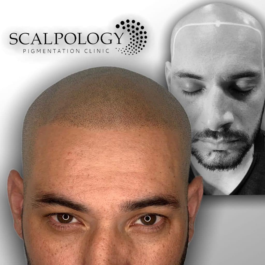 scalp micropigmentation before after-Scalpology