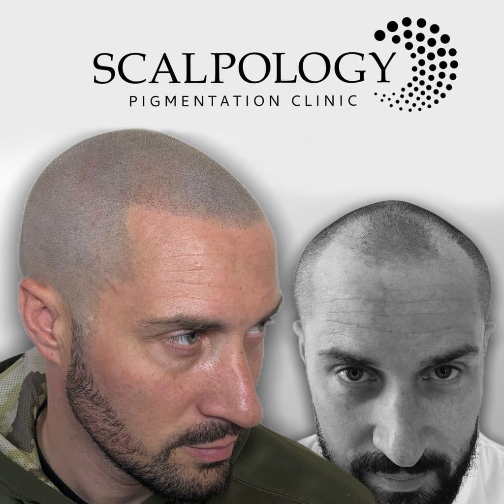 scalp micropigmentation frontal fibrosing alopecia-Scalpology