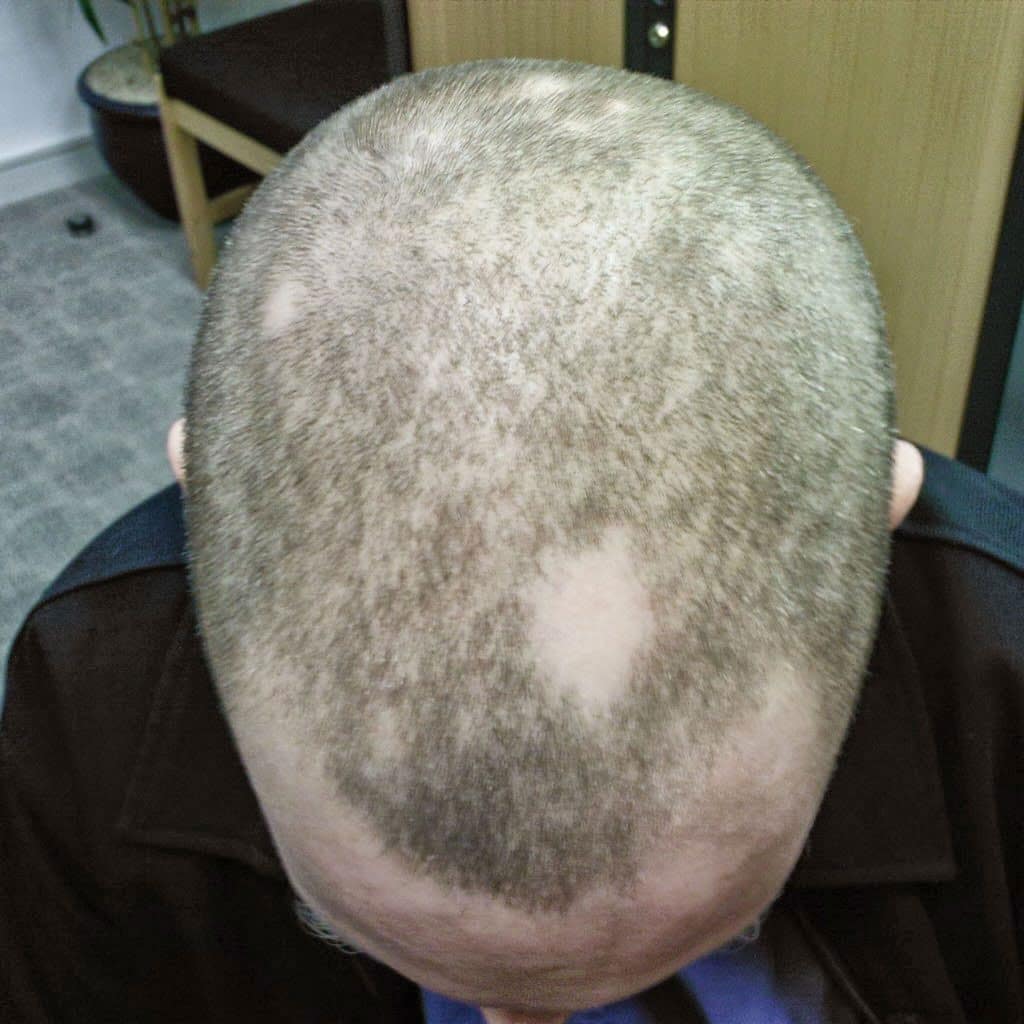 scalp micropigmentation for alopecia-Scalpology