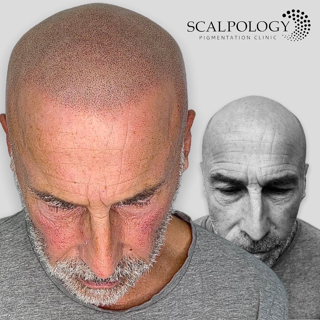 Best clinics for scalp micropigmentation in Lambeth, London