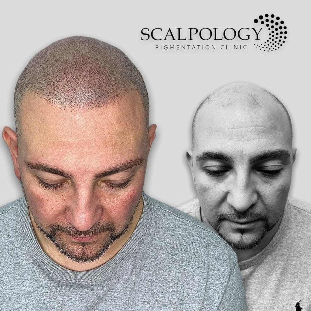Best clinics for scalp micropigmentation in Lambeth, London