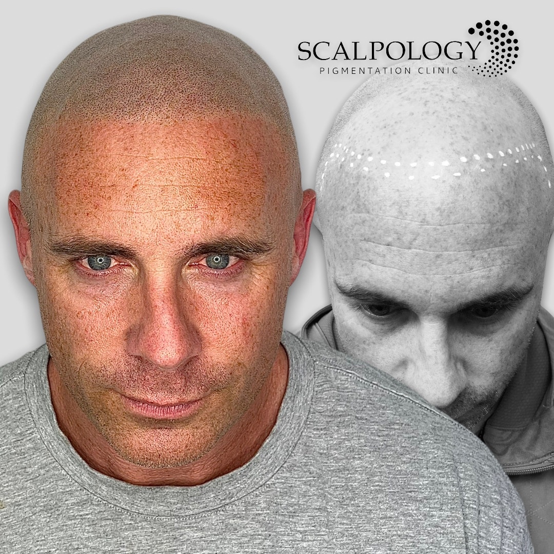 Best clinics for scalp micropigmentation in Lambeth, London